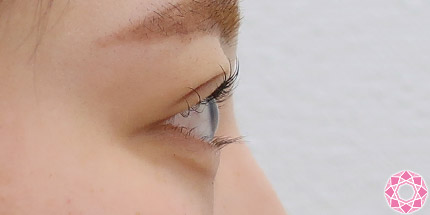 年代：20代 施術名：二重埋没法 施術後｜【公式】東京形成美容外科