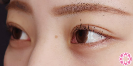 年代：20代 施術名：二重埋没法 施術前｜【公式】東京形成美容外科