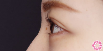 年代：20代 施術名：二重埋没法 施術前｜【公式】東京形成美容外科