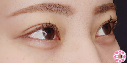 年代：20代 施術名：二重埋没法 施術前｜【公式】東京形成美容外科