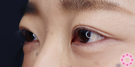 年代：30代 施術名：二重埋没法 施術後｜【公式】東京形成美容外科