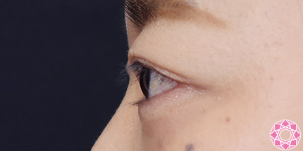 年代：30代 施術名：二重埋没法 施術後｜【公式】東京形成美容外科