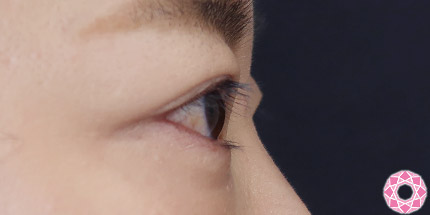 年代：30代 施術名：二重埋没法 施術後｜【公式】東京形成美容外科