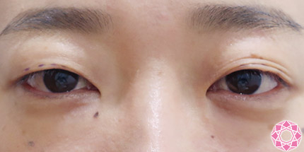 年代：30代 施術名：二重埋没法 施術前｜【公式】東京形成美容外科