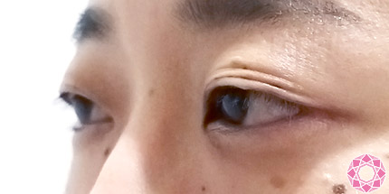 年代：30代 施術名：二重埋没法 施術前｜【公式】東京形成美容外科