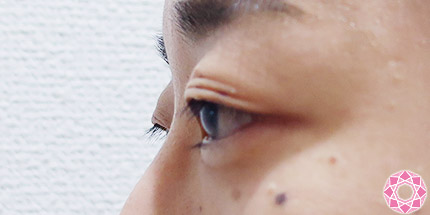 年代：30代 施術名：二重埋没法 施術前｜【公式】東京形成美容外科