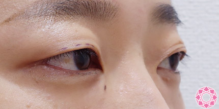 年代：30代 施術名：二重埋没法 施術前｜【公式】東京形成美容外科