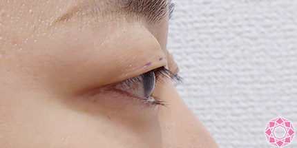 年代：30代 施術名：二重埋没法 施術前｜【公式】東京形成美容外科