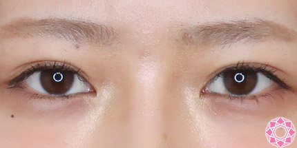 年代：20代 施術名：二重埋没法 施術後｜【公式】東京形成美容外科