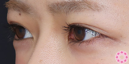 年代：20代 施術名：二重埋没法 施術後｜【公式】東京形成美容外科