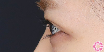 年代：20代 施術名：二重埋没法 施術後｜【公式】東京形成美容外科