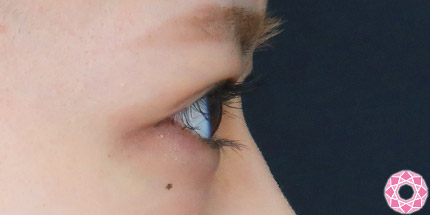 年代：20代 施術名：二重埋没法 施術後｜【公式】東京形成美容外科