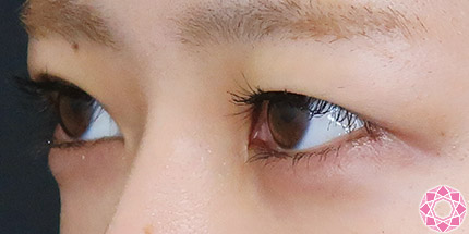 年代：20代 施術名：二重埋没法 施術前｜【公式】東京形成美容外科