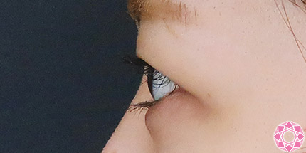 年代：20代 施術名：二重埋没法 施術前｜【公式】東京形成美容外科