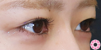 年代：20代 施術名：二重埋没法 施術前｜【公式】東京形成美容外科