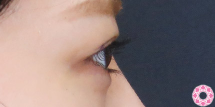 年代：20代 施術名：二重埋没法 施術前｜【公式】東京形成美容外科