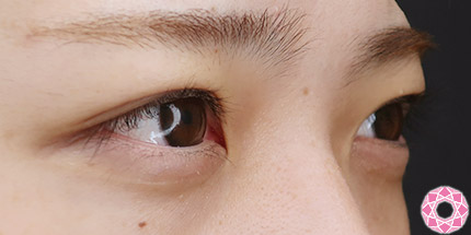 年代：10代 施術名：二重埋没法 施術後｜【公式】東京形成美容外科