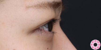 年代：10代 施術名：二重埋没法 施術後｜【公式】東京形成美容外科