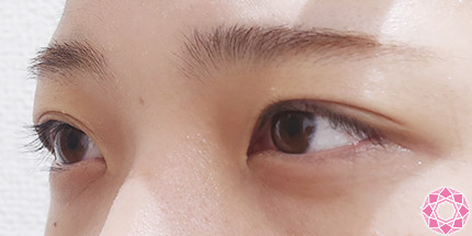 年代：10代 施術名：二重埋没法 施術前｜【公式】東京形成美容外科