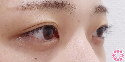 年代：10代 施術名：二重埋没法 施術前｜【公式】東京形成美容外科