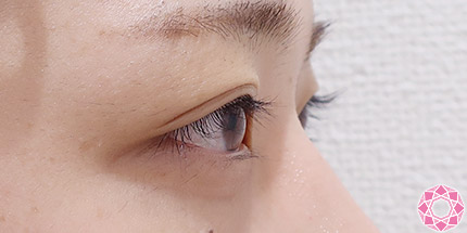 年代：10代 施術名：二重埋没法 施術前｜【公式】東京形成美容外科