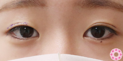 年代：10代 施術名：二重埋没法 施術前｜【公式】東京形成美容外科