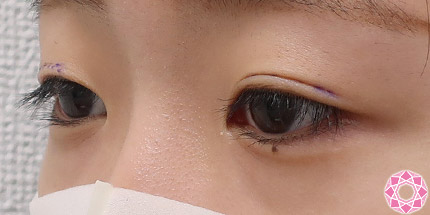 年代：10代 施術名：二重埋没法 施術前｜【公式】東京形成美容外科