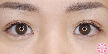 年代：30代 施術名：二重埋没法 施術後｜【公式】東京形成美容外科