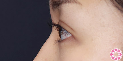 年代：30代 施術名：二重埋没法 施術後｜【公式】東京形成美容外科