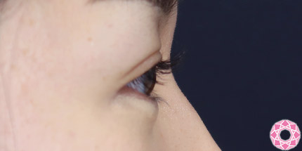 年代：30代 施術名：二重埋没法 施術後｜【公式】東京形成美容外科