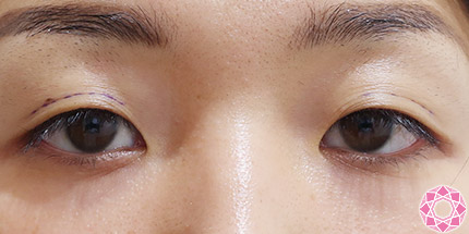 年代：30代 施術名：二重埋没法 施術前｜【公式】東京形成美容外科