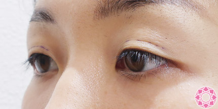 年代：30代 施術名：二重埋没法 施術前｜【公式】東京形成美容外科