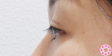 年代：30代 施術名：二重埋没法 施術前｜【公式】東京形成美容外科