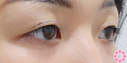 年代：30代 施術名：二重埋没法 施術前｜【公式】東京形成美容外科