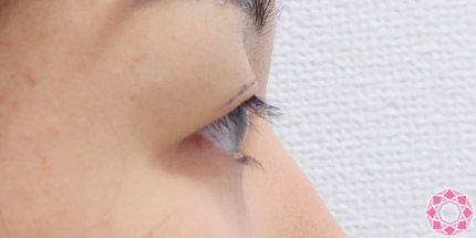 年代：30代 施術名：二重埋没法 施術前｜【公式】東京形成美容外科