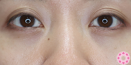 年代：30代 施術名：目の下のふくらみ取り 施術後｜【公式】東京形成美容外科