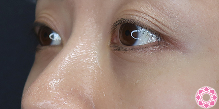 年代：30代 施術名：目の下のふくらみ取り 施術後｜【公式】東京形成美容外科