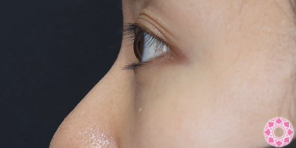 年代：30代 施術名：目の下のふくらみ取り 施術後｜【公式】東京形成美容外科