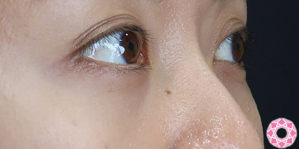 年代：30代 施術名：目の下のふくらみ取り 施術後｜【公式】東京形成美容外科