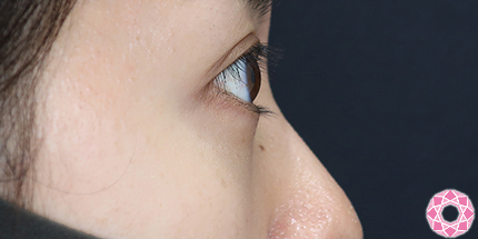 年代：30代 施術名：目の下のふくらみ取り 施術後｜【公式】東京形成美容外科