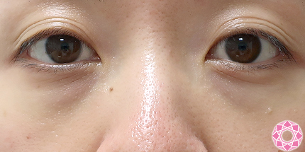 年代：30代 施術名：目の下のふくらみ取り 施術前｜【公式】東京形成美容外科