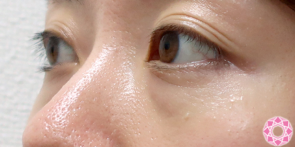 年代：30代 施術名：目の下のふくらみ取り 施術前｜【公式】東京形成美容外科