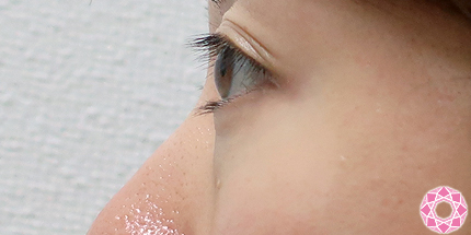 年代：30代 施術名：目の下のふくらみ取り 施術前｜【公式】東京形成美容外科