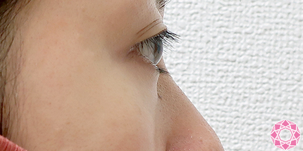 年代：30代 施術名：目の下のふくらみ取り 施術前｜【公式】東京形成美容外科