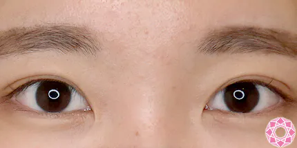 年代：20代 施術名：二重埋没法 施術後｜【公式】東京形成美容外科