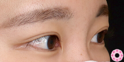 年代：20代 施術名：二重埋没法 施術後｜【公式】東京形成美容外科