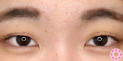 年代：20代 施術名：二重埋没法 施術前｜【公式】東京形成美容外科