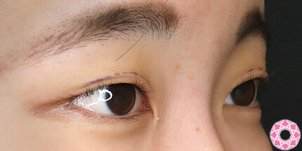 年代：20代 施術名：二重埋没法 施術前｜【公式】東京形成美容外科