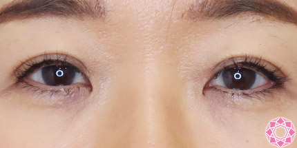 年代：50代 施術名：二重埋没法 施術後｜【公式】東京形成美容外科