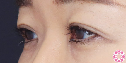 年代：50代 施術名：二重埋没法 施術後｜【公式】東京形成美容外科